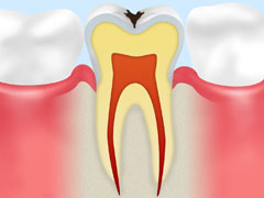 【C1】エナメル質のむし歯