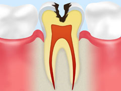 【C2】象牙質のむし歯