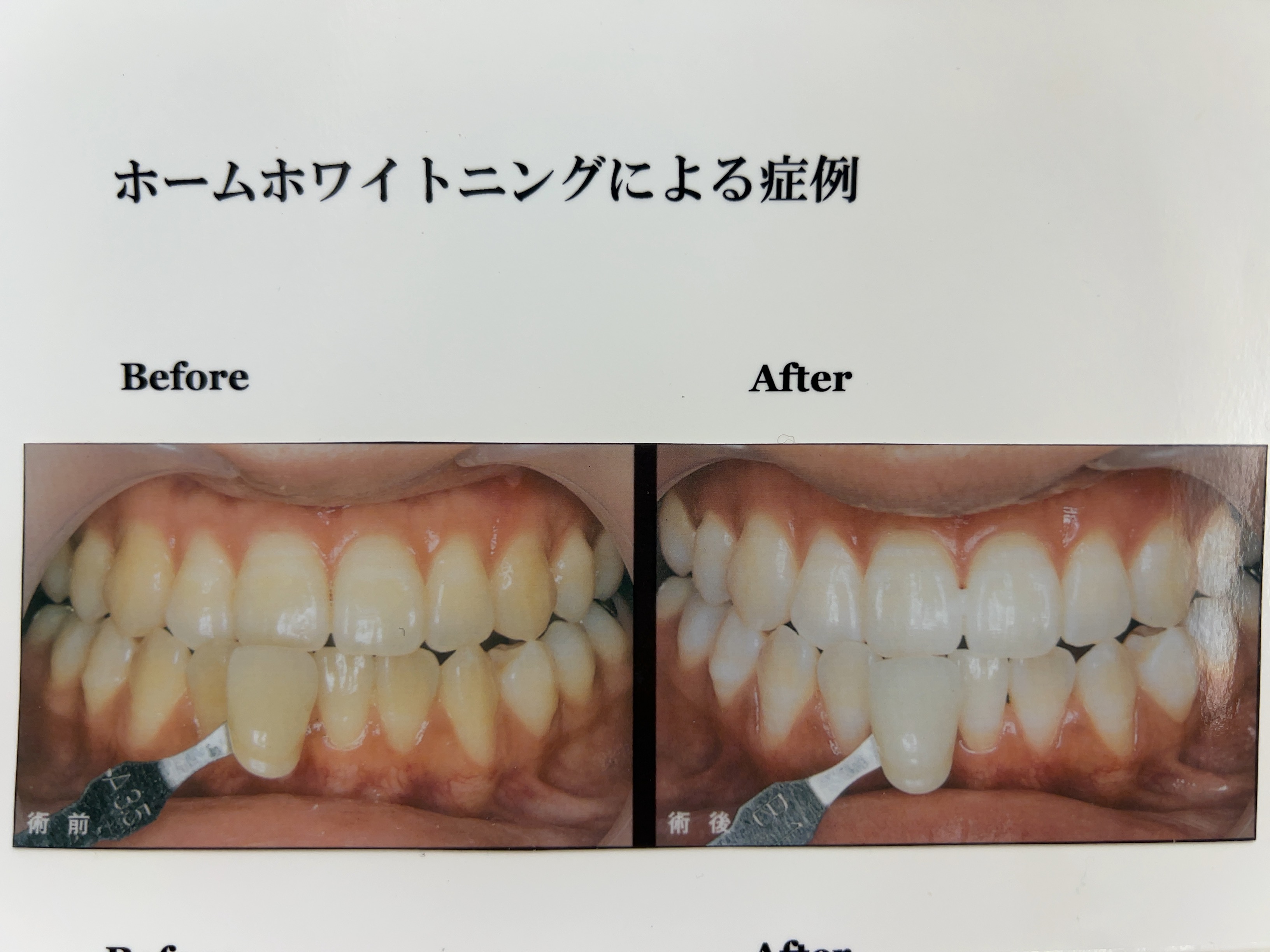 ホワイトニングの種類